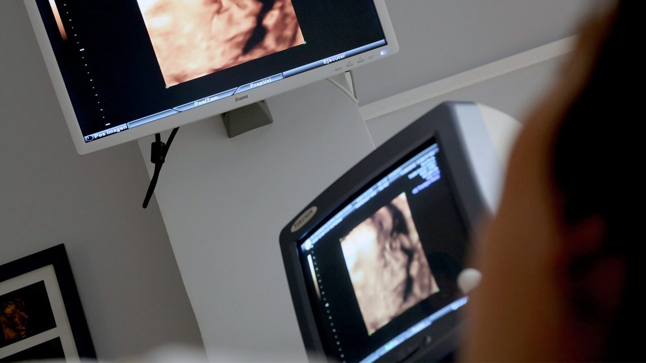 3D-vs-4D-ultrasound